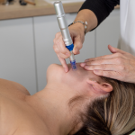 mejores tratamientos faciales zaragoza dermapen