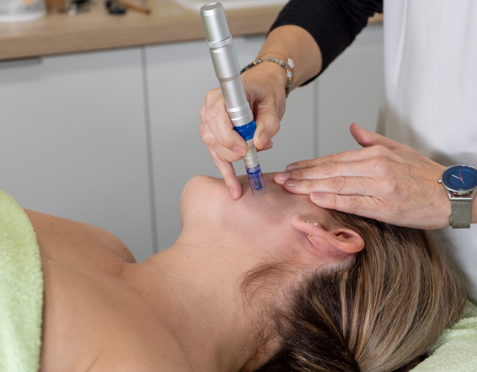 mejores tratamientos faciales zaragoza dermapen